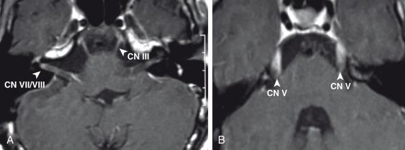 Figure 34.18, Lyme disease.