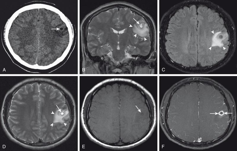 Figure 34.19, Cysticercosis.