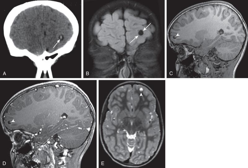 e-Figure 34.20, Cysticercosis.