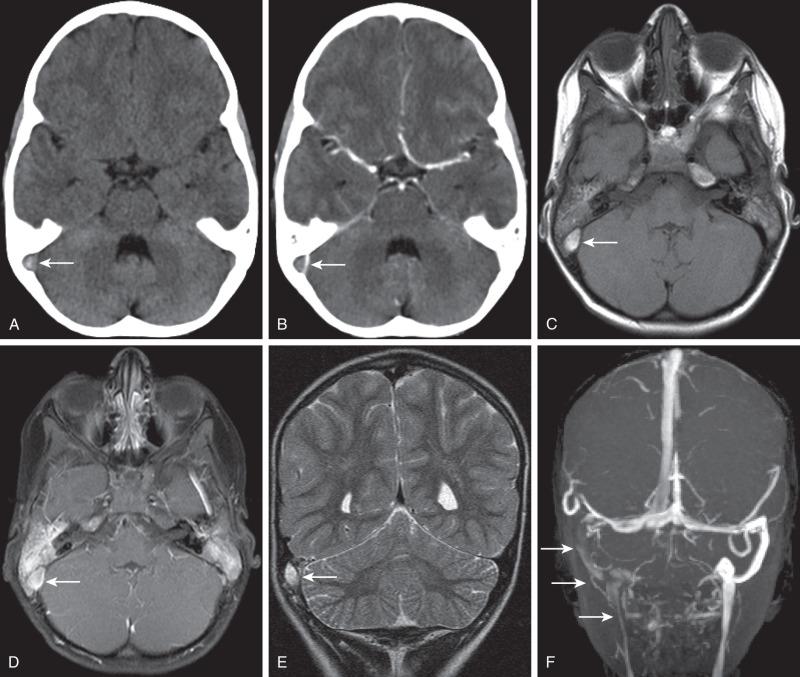 Figure 34.3, Transverse sinus thrombosis associated with otomastoiditis and middle ear disease.