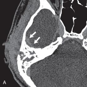 Figure 34.4, Mastoiditis with associated epidural abscess.