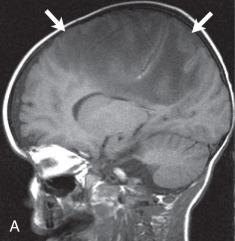 Figure 34.6, Cerebritis.