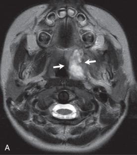 e-Figure 34.2, Parameningeal spread of retropharyngeal infection.