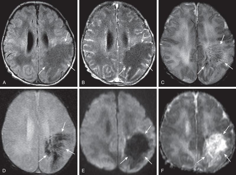 Figure 34.7, Citrobacter infection with secondary venous thrombosis.