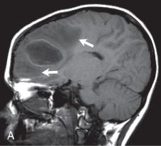 Figure 34.9, Cerebral abscess.