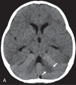 Figure 34.10, Meningitis and brain death.