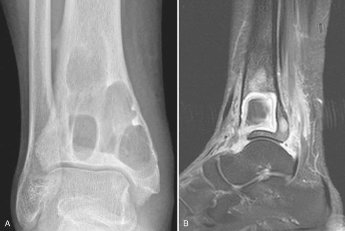 Figure 14.11, Brodie abscess.