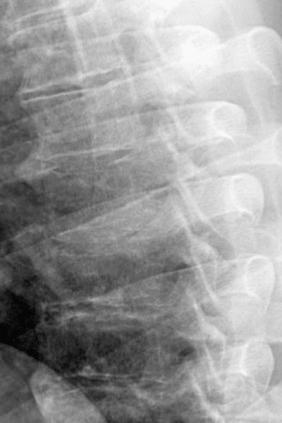 Figure 14.12, Osteomyelitis of spine. Lateral x-ray showing loss of subchondral bone plate and adjacent bone lysis.