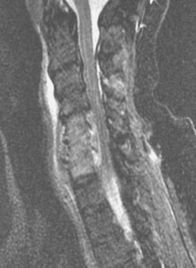 Figure 14.14, Osteomyelitis of vertebral body with epidural abscess.