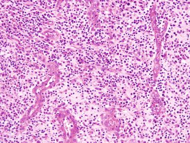 Figure 14.17, Acute and chronic osteomyelitis with neutrophils, lymphocytes, plasma cells, macrophages, and capillaries.