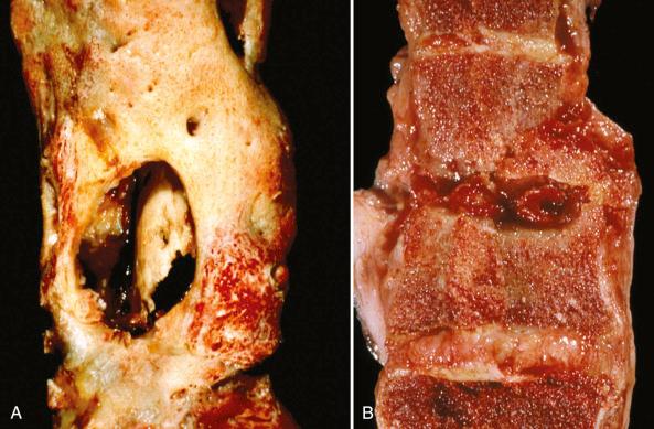 Figure 14.19, Gross specimens of osteomyelitis.