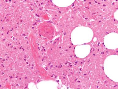 Figure 14.2, Early stage of acute osteomyelitis with thrombosis, neutrophils, fibrin, platelets, hemorrhage, and necrosis.