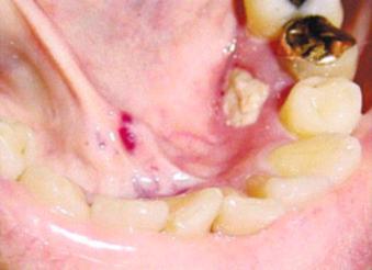 Figure 14.21, Patient treated with intravenous bisphosphonate who after an extraction developed exposed bone infected with actinomycosis, which is also necrotic.