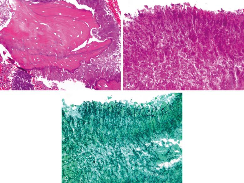 Figure 14.22, Actinomycosis of mandible.