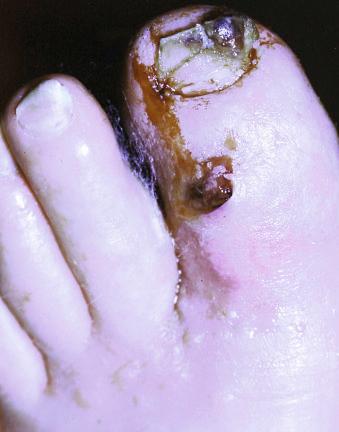 Figure 14.23, Great toe of elderly diabetic patient.