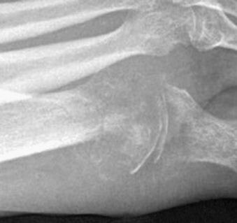 Figure 14.24, Lateral radiograph of the first metatarsophalangeal joint shows osteopenia, loss of joint space, and destruction of the adjacent bones, especially the metatarsal head.