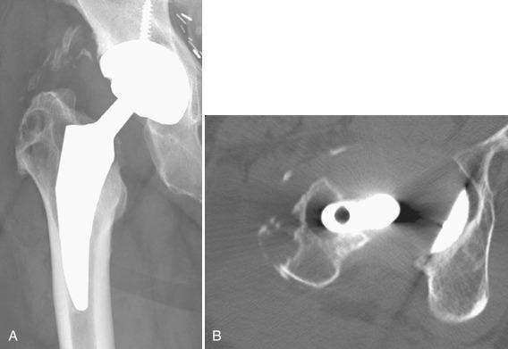 Figure 14.25, Hip prosthesis with heterotopic bone in soft tissues and infection of the femoral component.