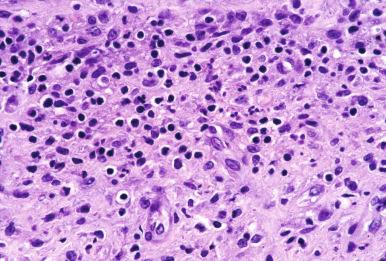 Figure 14.26, Removed synovial-like tissue from the region around the femoral component. The neutrophils are indicative of infection.