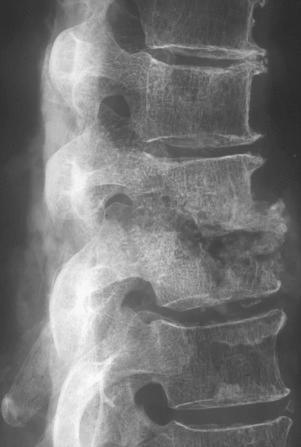 Figure 14.27, Tuberculosis of thoracic spine demonstrating destruction of adjacent vertebral bodies and the intervening disc. The anterior portions of the bodies are most severely affected.