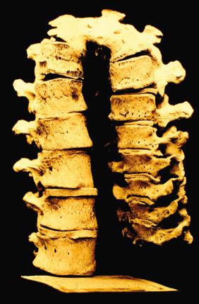 Figure 14.28, Severe kyphosis caused by collapsed vertebral body as a result of tuberculosis.