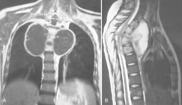 Figure 14.29, Tuberculosis spine. T-2 weighted MRI of tuberculosis of vertebrae with abscess extending bilaterally.