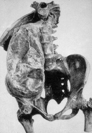 Figure 14.30, Tuberculosis of spine with formation of large abscess that dissected along the psoas. The wall of the abscess is calcified.