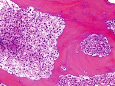 Figure 14.3, Sheets of neutrophils filling haversian systems.