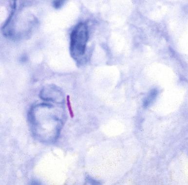 Figure 14.33, Acid-fast stain showing beaded rod shape of Mycobacterium tuberculosis in cytoplasm of histiocyte.