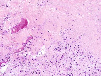 Figure 14.34, Necrotizing granulomas with pieces of dead bone in Mycobacterium avium-intracellulare osteomyelitis of tibia.