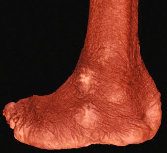 Figure 14.35, Leprosy of foot.