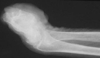 Figure 14.37, Oblique lateral radiograph of the wrist and hand shows resorption of the phalanges and the distal metacarpals and the soft tissues. There is atrophy of the remaining soft tissues. No significant demineralization is evident.