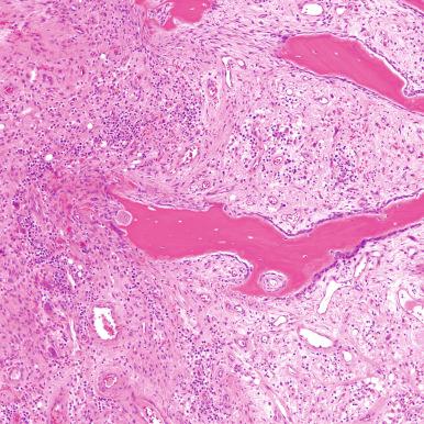 Figure 14.4, Acute and chronic osteomyelitis with inflammation filling the medullary cavity. Osteoclasts are resorbing the preexisting trabecular bone.