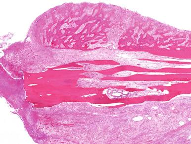 Figure 14.5, Medullary cavity filled with inflammation extending through the necrotic cortex (sequestrum) and associated with abundant viable subperiosteal reactive bone (involucrum).