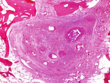 Figure 14.6, Brodie abscess composed of an intraosseous abscess walled off by reactive bone.