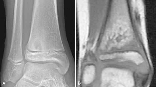 Figure 14.7, Acute osteomyelitis of distal tibia. A, Anteroposterior radiograph shows poorly defined area of osteolysis with minimal surrounding sclerosis in the distal tibial metaphysis. B, Coronal T1 magnetic resonance imaging demonstrates irregular dark area composed of inflammatory tissue surrounded by a dark zone of edema adjacent to the plate medially.