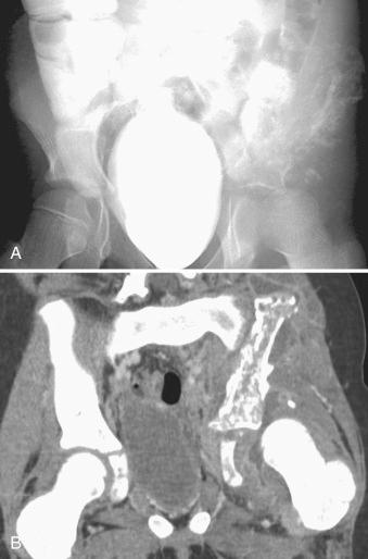 Figure 14.9, Acute and chronic osteomyelitis of pelvis.