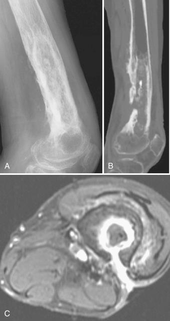 Figure 14.10, Acute and chronic osteomyelitis with soft tissue abscess and sinus tract.