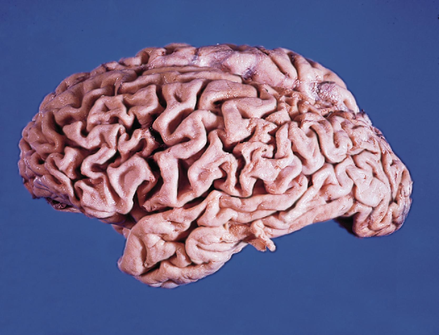 FIGURE 7.11, Neurosyphilis. In paretic neurosyphilis, there is prominent frontal atrophy.