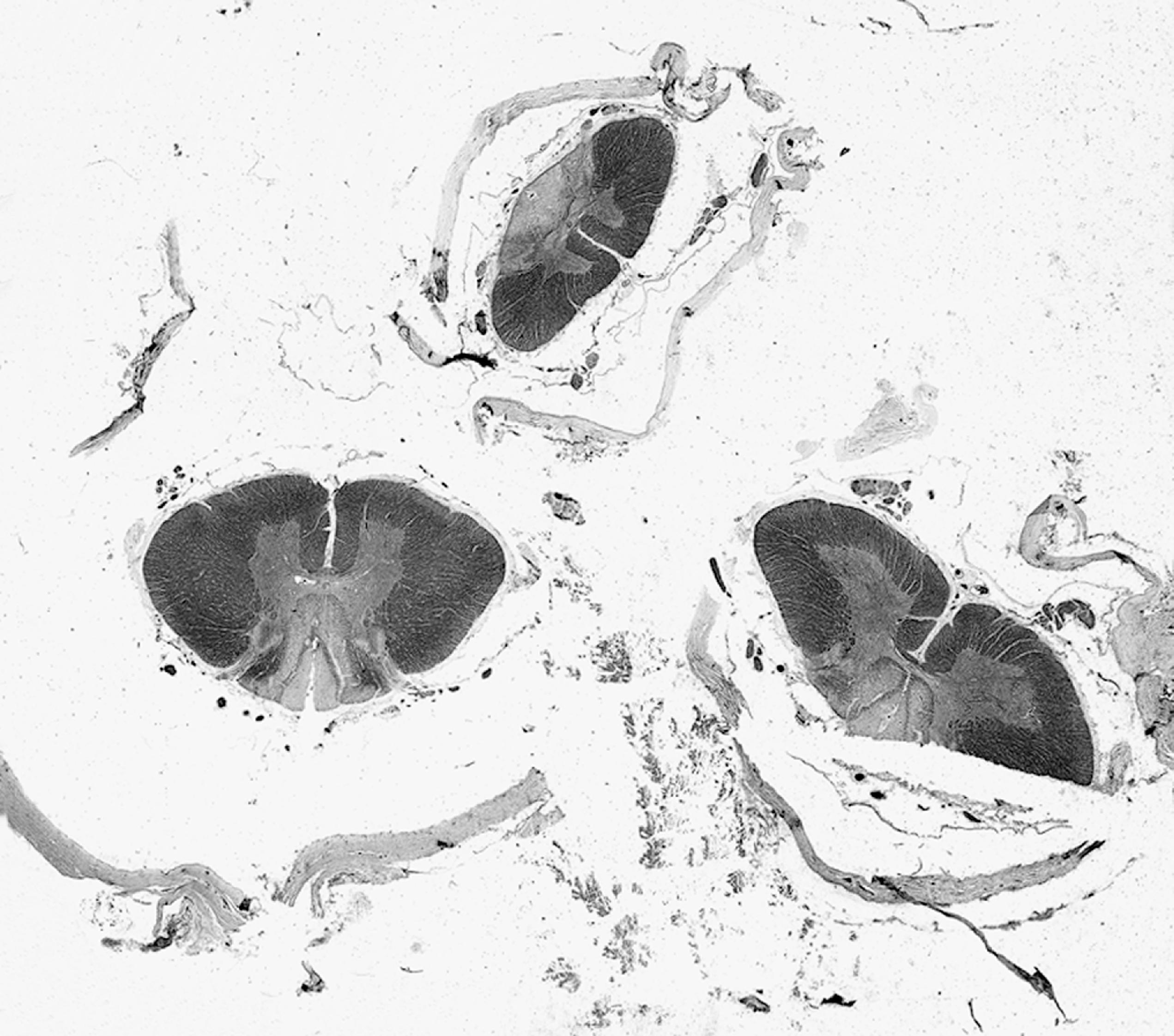 FIGURE 7.12, Neurosyphilis. In tabes dorsalis, there is myelin loss affecting the posterior columns of the spinal cord (Luxol fast blue myelin stain).