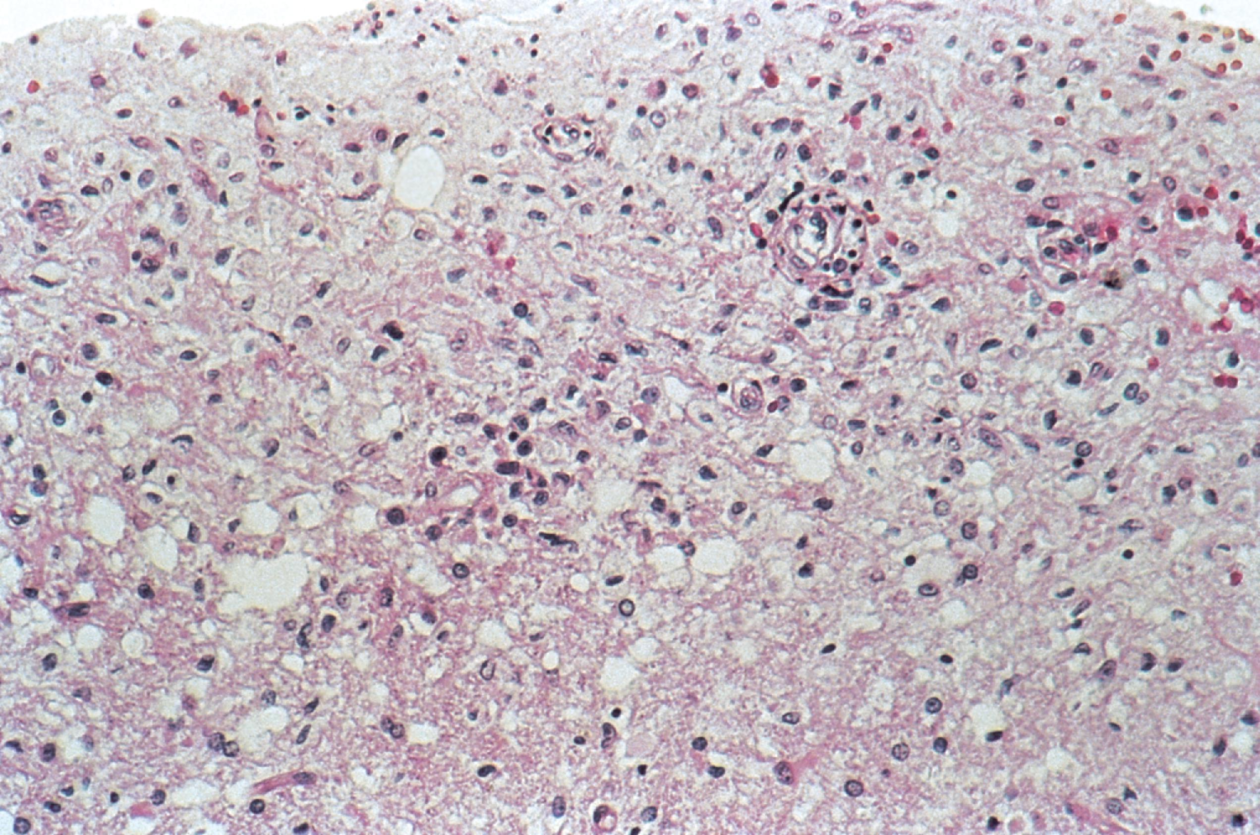 FIGURE 7.13, Whipple disease. Microscopic findings in Whipple disease consist of an inflammatory infiltrate that is composed predominantly of macrophages and associated with reactive astrocytosis.