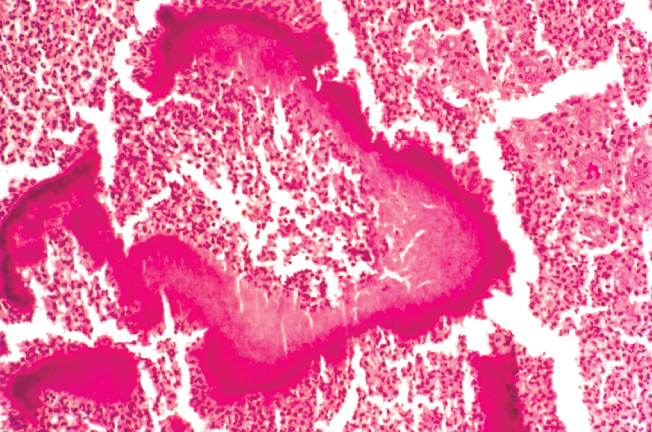 FIGURE 7.14, Actinomycosis. The sulfur granule, which is characteristic of actinomycosis, is a purplish mass of filamentous organisms.