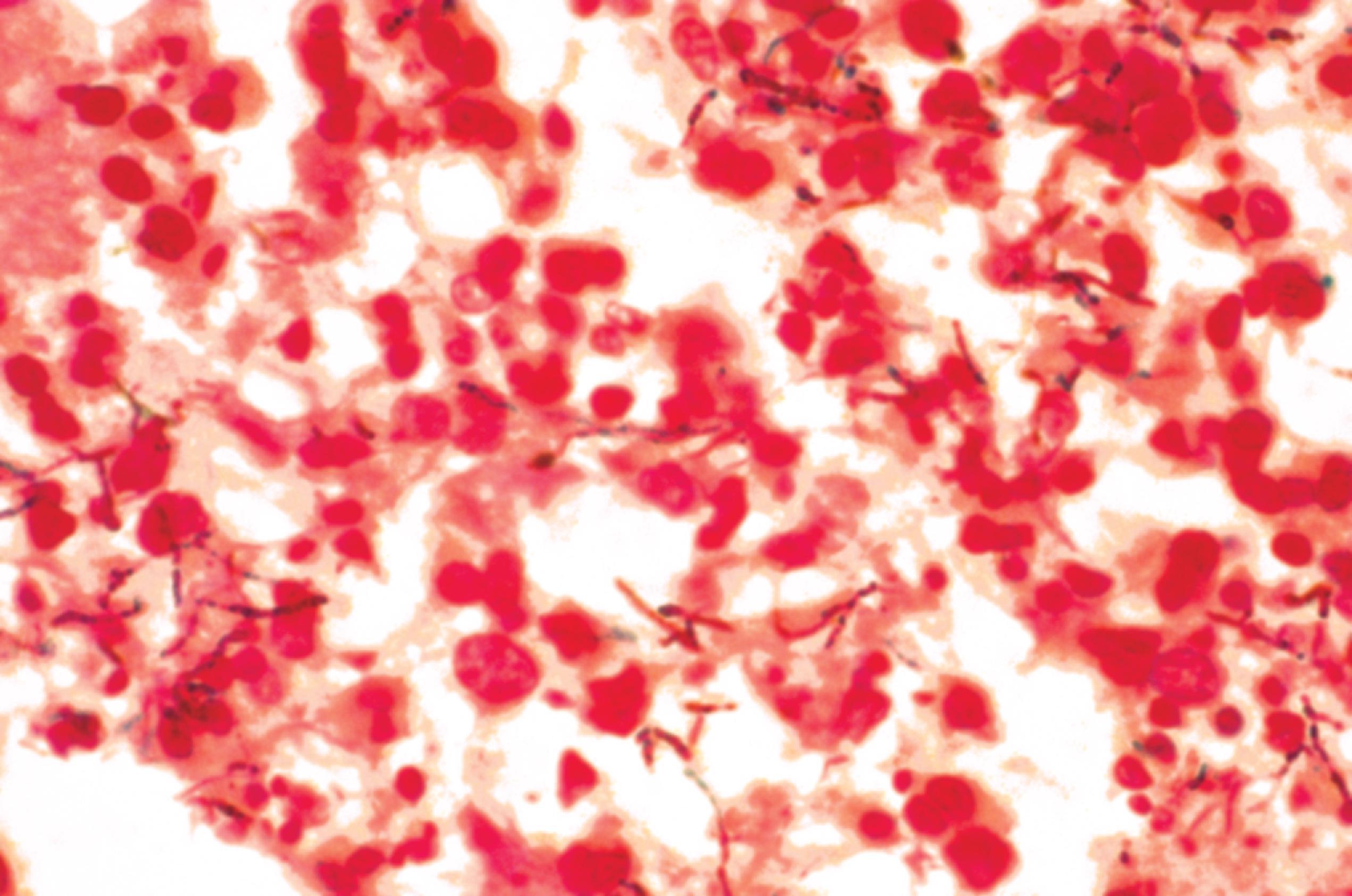 FIGURE 7.16, Nocardiosis. The organisms are thin, branching filaments (tissue Gram stain).