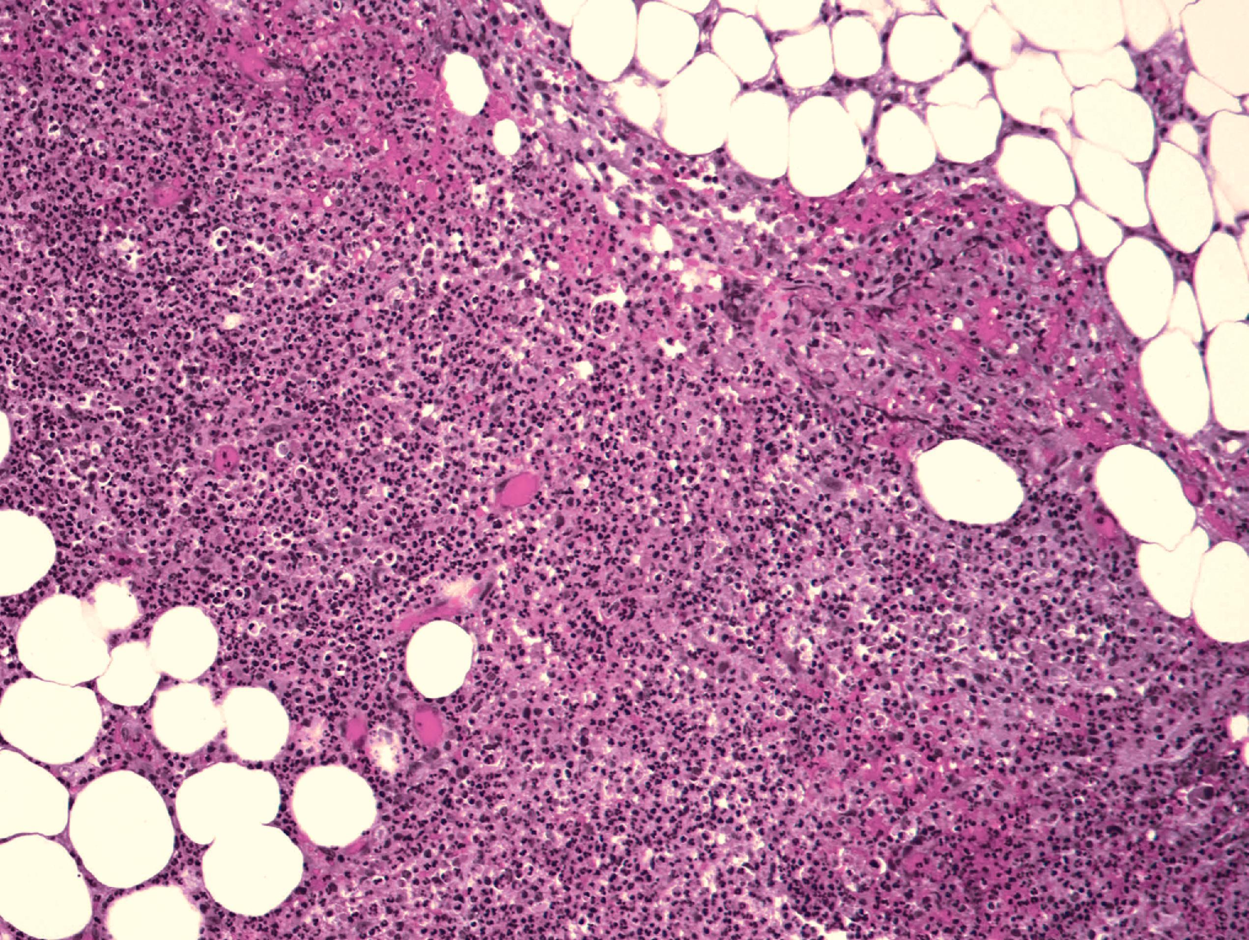 FIGURE 7.17, Epidural abscess. Neutrophils infiltrate the adipose tissue of the epidural space.