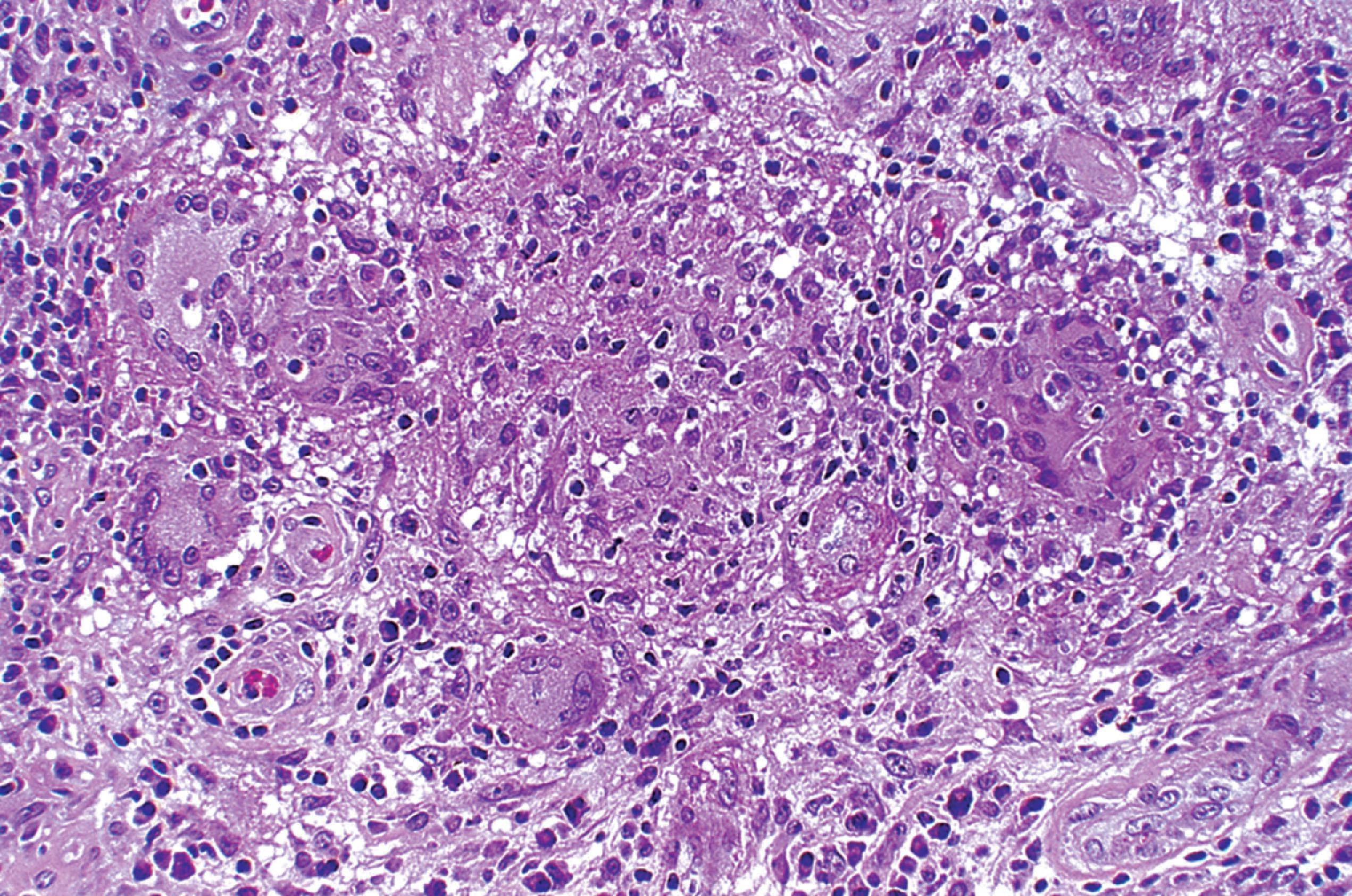 FIGURE 7.18, Neurosarcoidosis. As in other organ systems, sarcoidosis of the CNS is characterized by nonnecrotizing granulomatous inflammation.