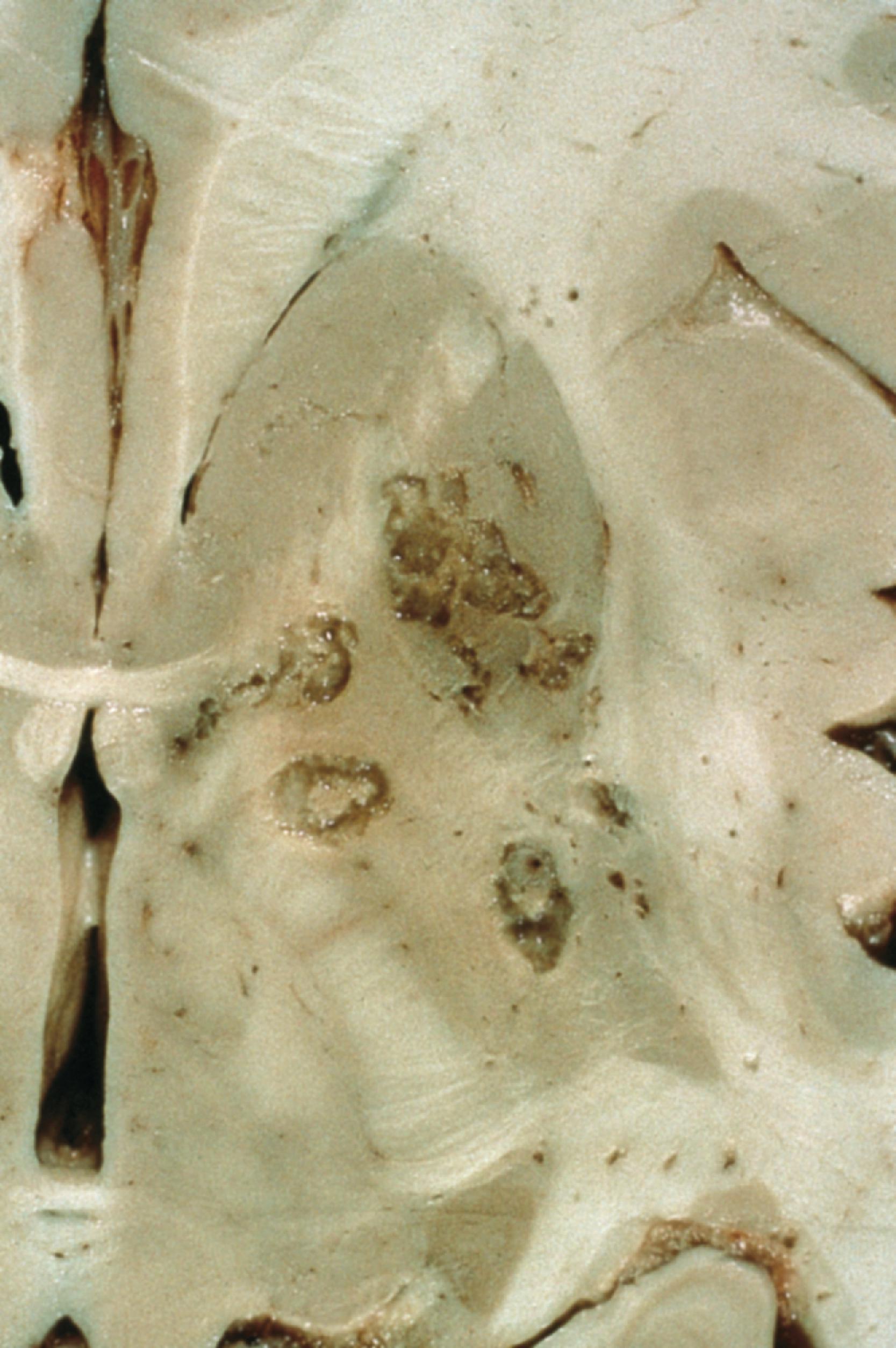 FIGURE 7.19, Cryptococcosis. Lesions with a soap bubble appearance are characteristic and are typically found in the basal ganglia.