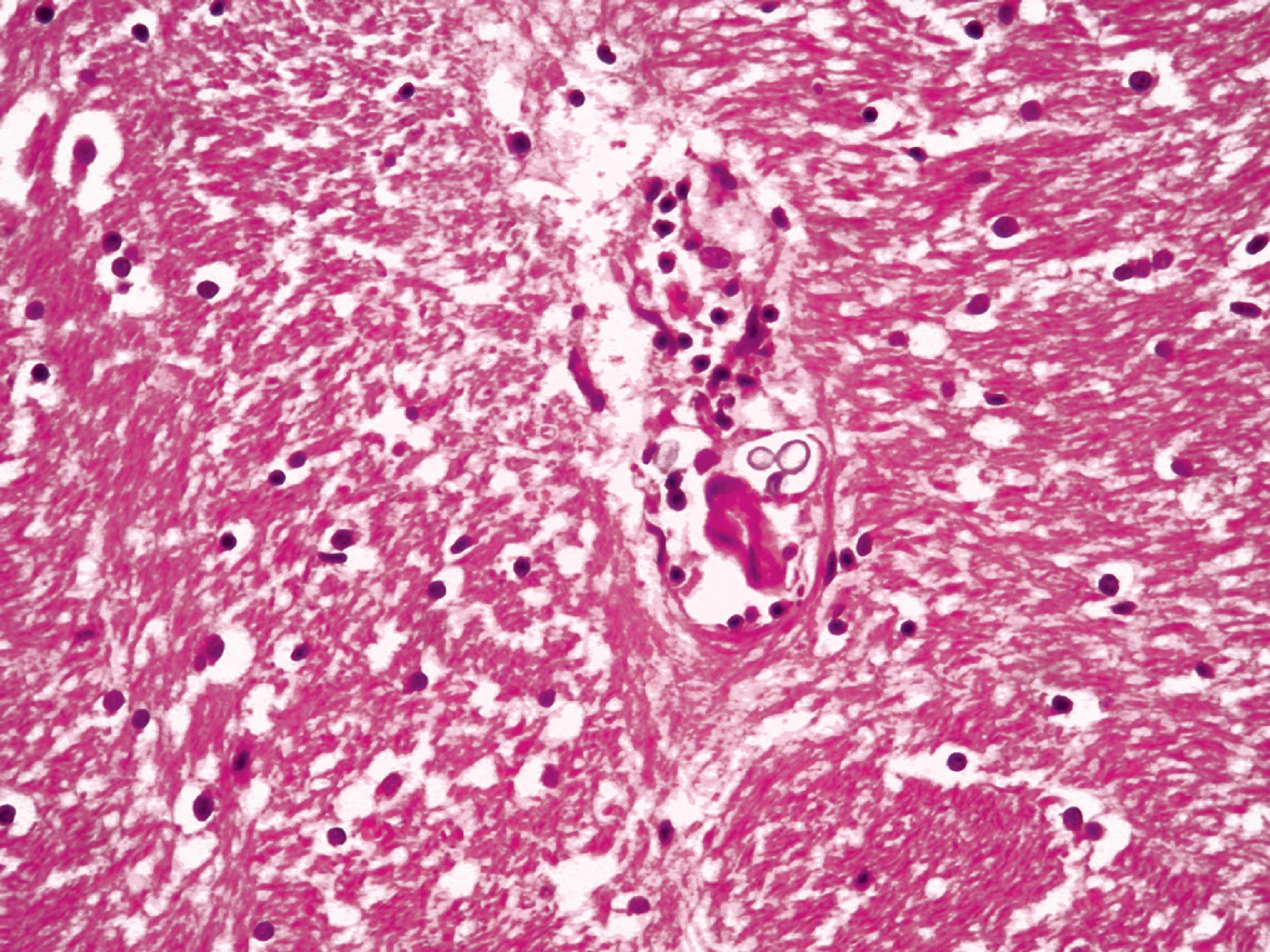 FIGURE 7.20, Cryptococcosis. The yeasts causing cryptococcosis are faintly staining and tend to cluster about blood vessels. Budding forms may be present.