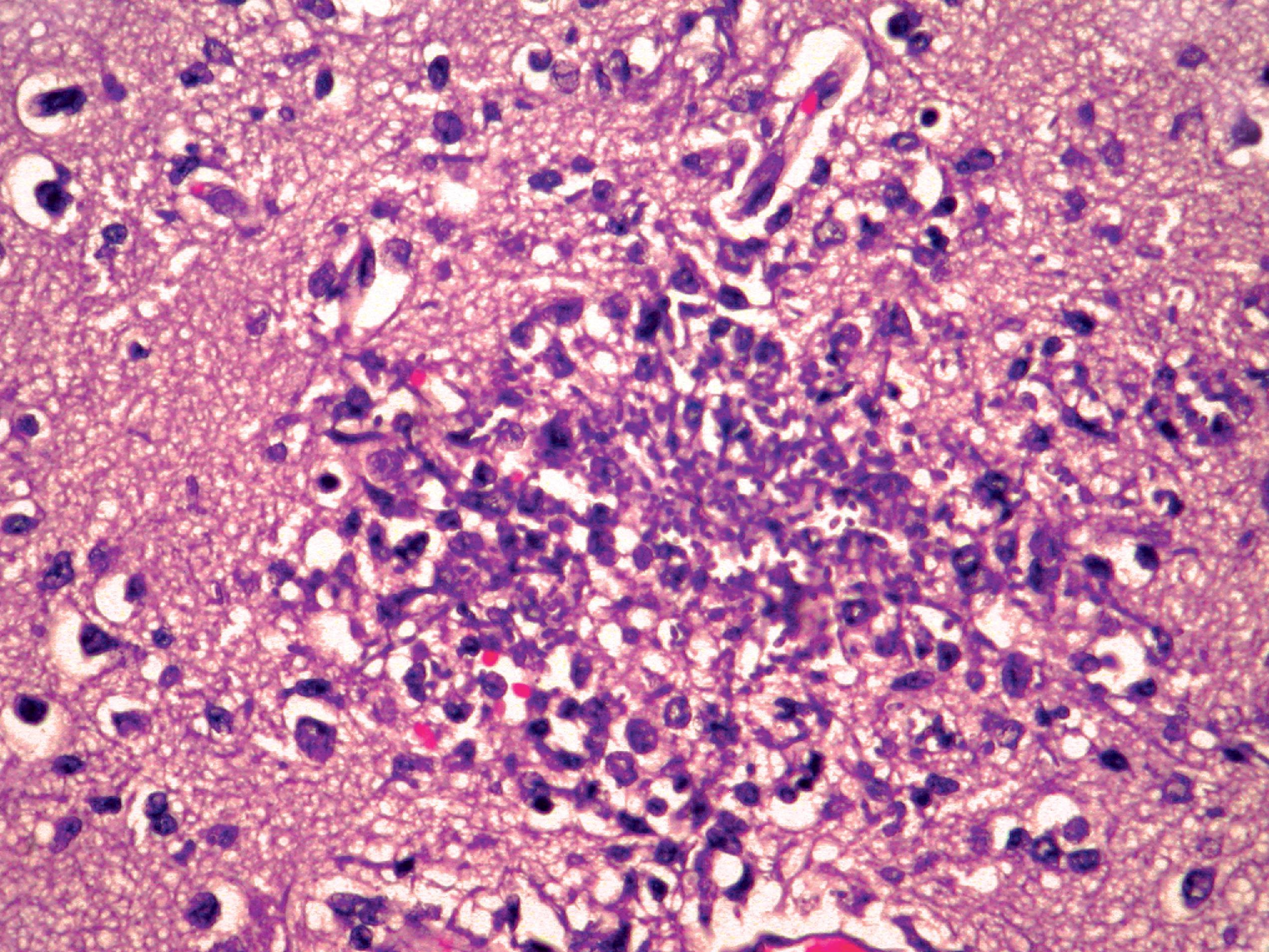 FIGURE 7.21, Candidiasis. Candidiasis of the CNS is characterized by multiple microscopic abscesses. The organisms are faintly basophilic in H&E-stained sections.