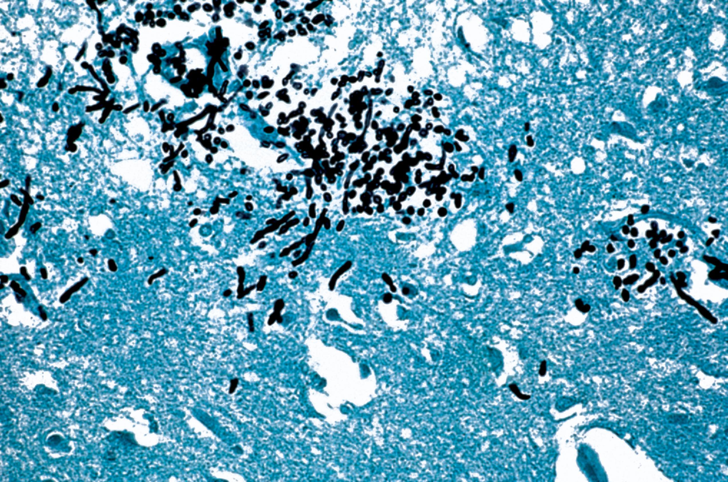 FIGURE 7.22, Candidiasis. The organisms are highlighted by a methenamine silver stain. Both yeast forms and pseudohyphae are present.