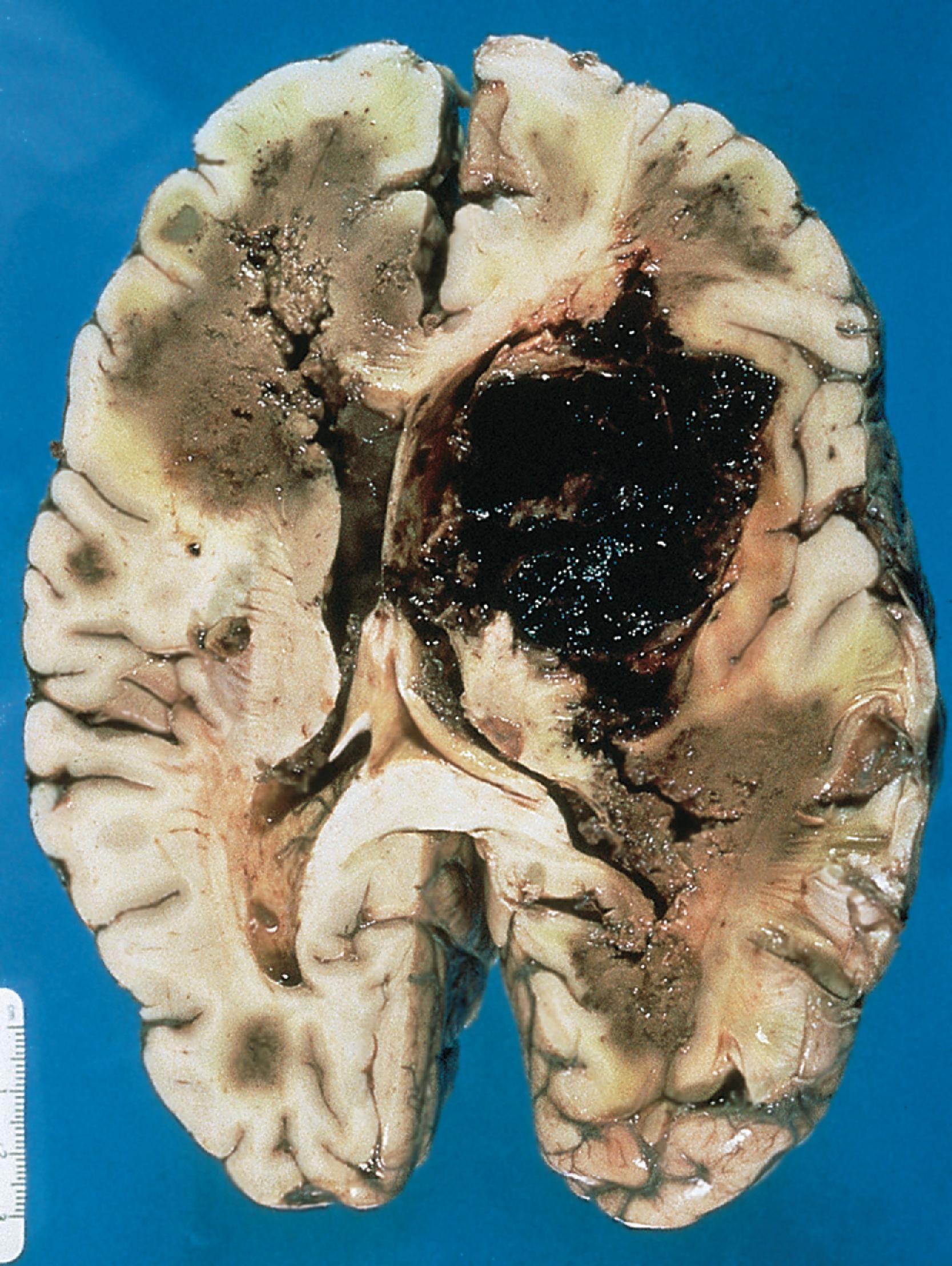 FIGURE 7.23, Aspergillosis. Hemorrhagic abscesses are typical of aspergillosis and are characteristically found in the distribution of the anterior and middle cerebral arteries.