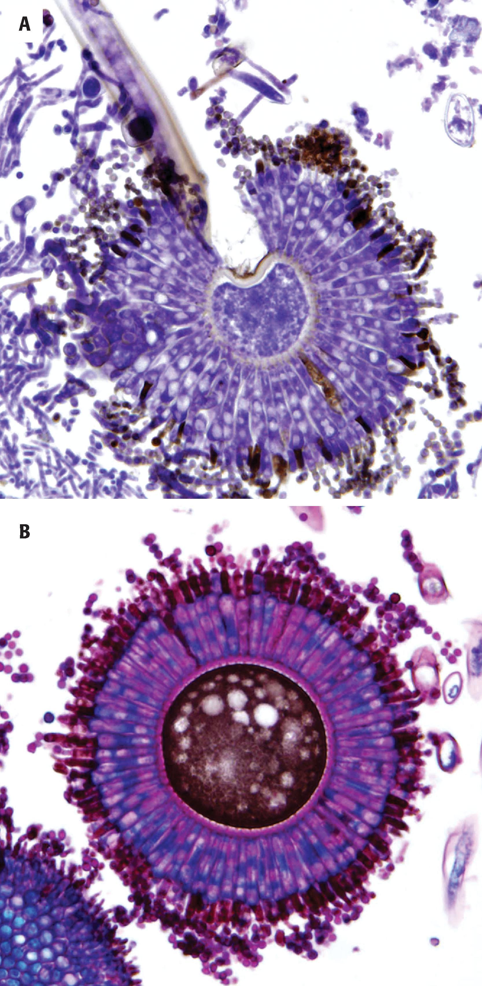 FIGURE 7.25, Aspergillosis. A, Fruiting bodies may be seen when organisms are exposed to air. B, The organisms are highlighted with a PAS stain.